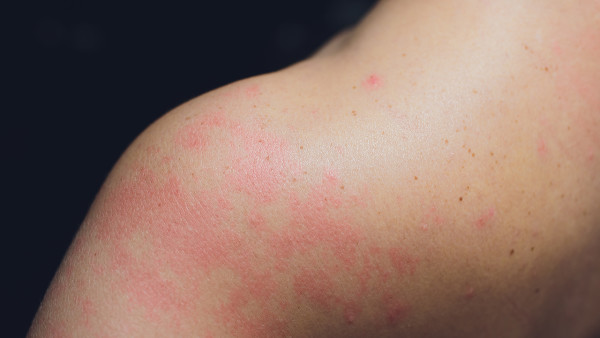 中医学讲解小儿湿疹发生的原因 家长必看