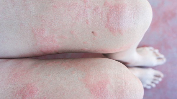 过敏体质婴儿易患湿疹照顾患儿留意五个层面