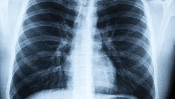 肺结核的短程化疗疗程一般是多久？（肺结核的治疗时间较短的情况有哪些？）