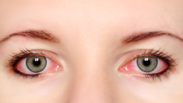 红眼病患者饮食注意事项有哪些？（红眼病患者在饮食方面有哪些注意事项？）