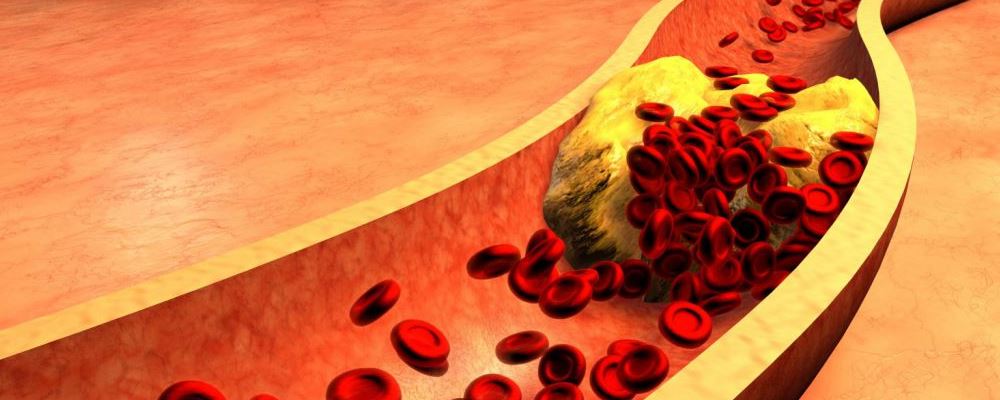 高血脂有哪些症状 高血脂的临床表现 高血脂的症状