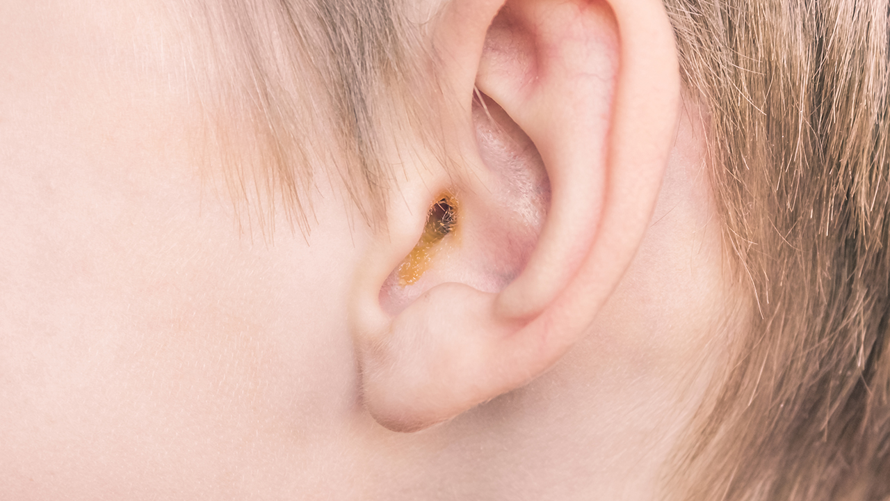 儿童中耳炎化脓的原因有哪些（儿童中耳炎化脓怎么办）
