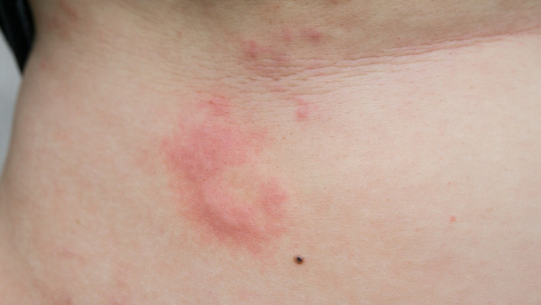 浑身荨麻疹是什么