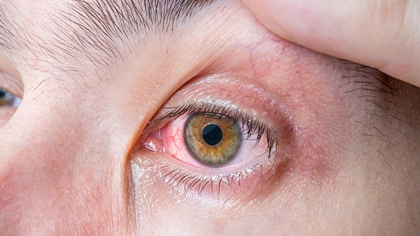 怎样知道干眼症是什么类型