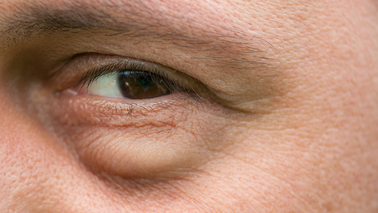 结膜炎，眼睛经常产生分泌物