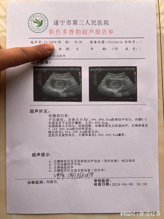 同房受精后最早7天左右尿液中会有HCG怀孕病历宫外孕病例怀孕血检