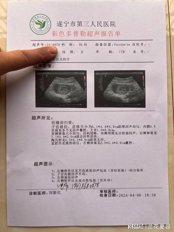 意外怀孕早孕流产后2周卵巢即可恢复排卵人流清单收据单怀孕病历